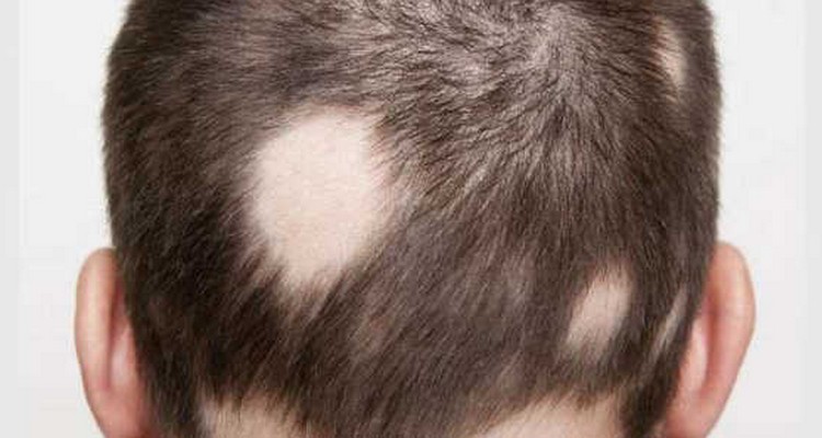 Alopezie Areata